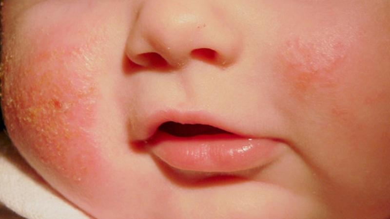 Bệnh nấm da mặt ở trẻ em, nguyên nhân, triệu chứng, cách điều trị và phòng ngừa hiệu quả