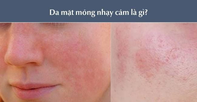 Cách chăm sóc da mỏng yếu hiệu quả giúp da khỏe mạnh