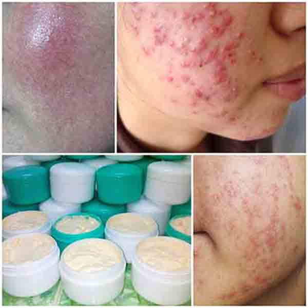 Corticoid trong mỹ phẩm là gì? tác dụng, lợi ích và rủi ro