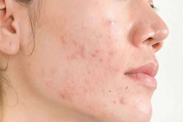 Dị ứng mỹ phẩm là gì?