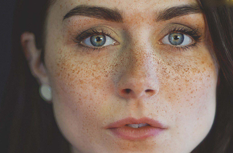 Hướng dẫn chi tiết về điều trị nám, phương pháp, lưu ý và sản phẩm hiệu quả