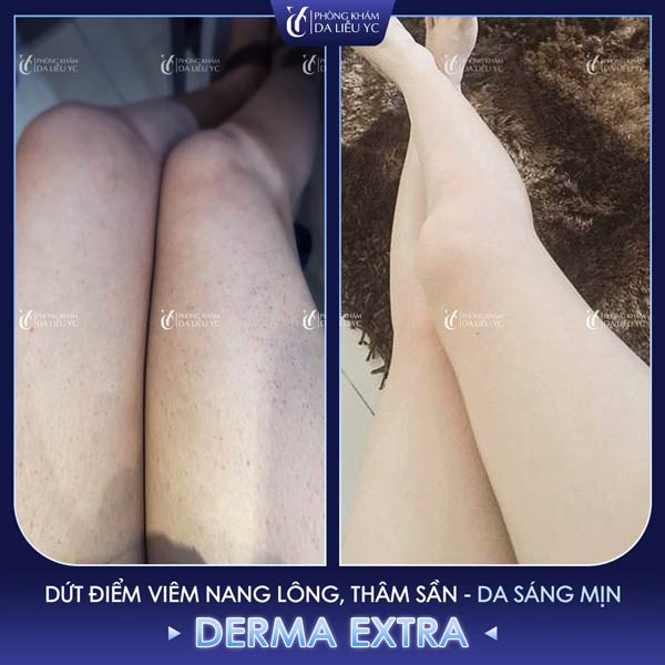 Spa trị viêm nang lông uy tín tại hà nội: top 10 Địa chỉ chất lượng và dịch vụ tốt nhất