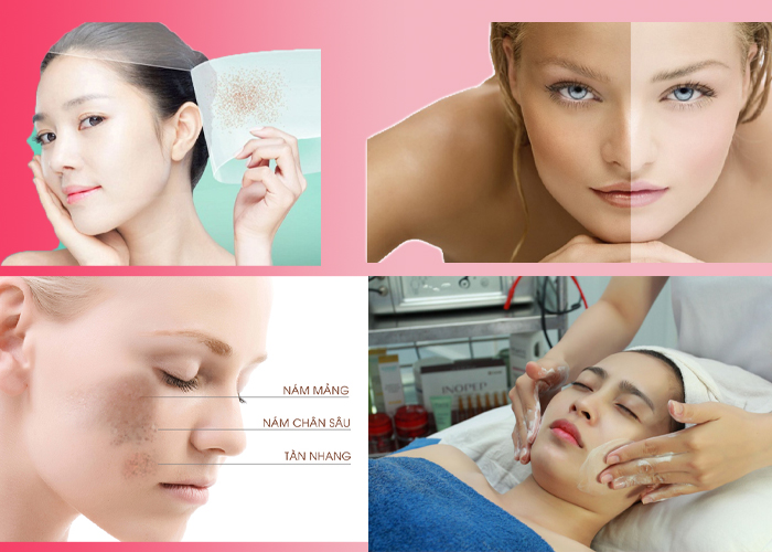 Trị nám tại spa: chi phí và thông tin cần biết